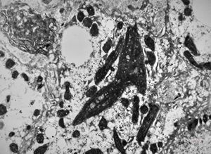 F,6y. | Wilson disease - megamitochondrion F,6y. | Wilson disease - megamitochondrion
